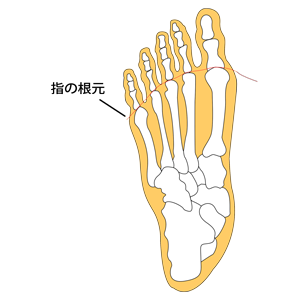 足の指が根元から無くなった