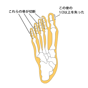 指の部分欠損