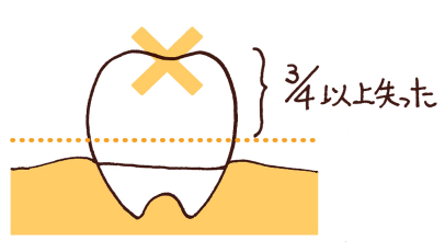 欠けた歯
