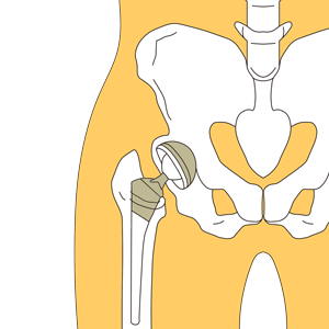人工股関節