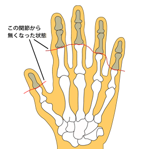 手の指を失った